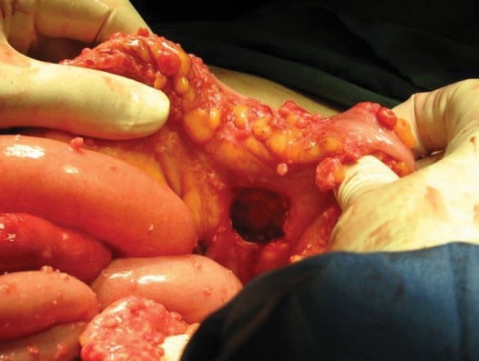 Figure 3. Internal herniation. Note the recto-sigmoid defect responsible for the closed-loop small bowel obstruction.
