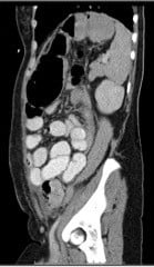 Figure 4. Mechanical large bowel obstruction. CT scan demonstrating a closed loop large bowel obstruction, secondary to extensive leiomyomatous adhesions cicatrizing the rectum and sigmoid.