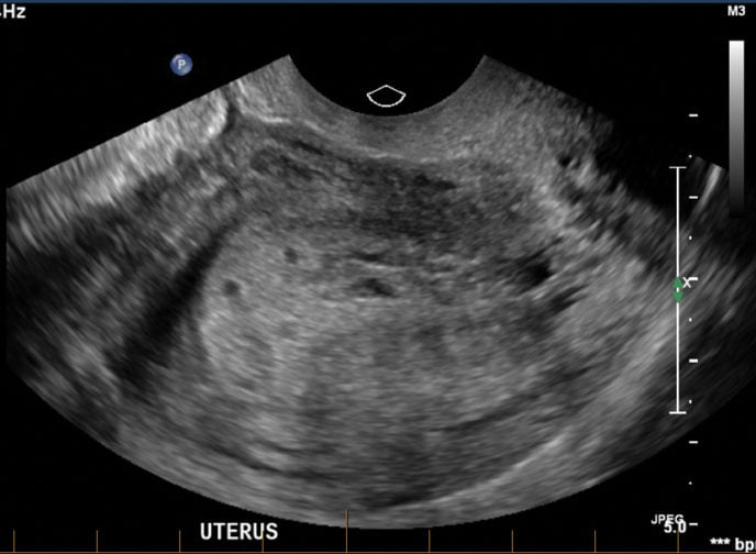 Ectopic pregnancy masquerading as a molar pregnancy – O&G Magazine