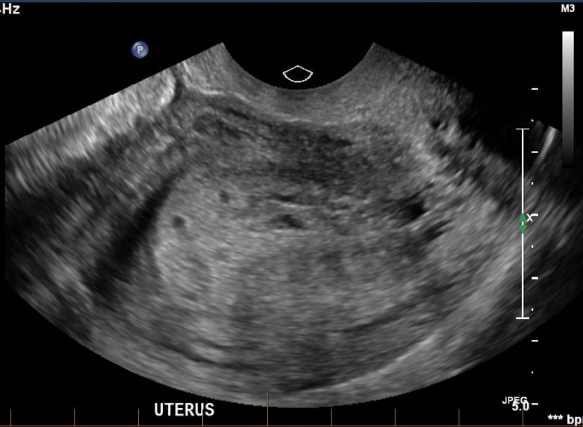 Figure 1. Ultrasound findings consistent with gestational throphoblastic disease.