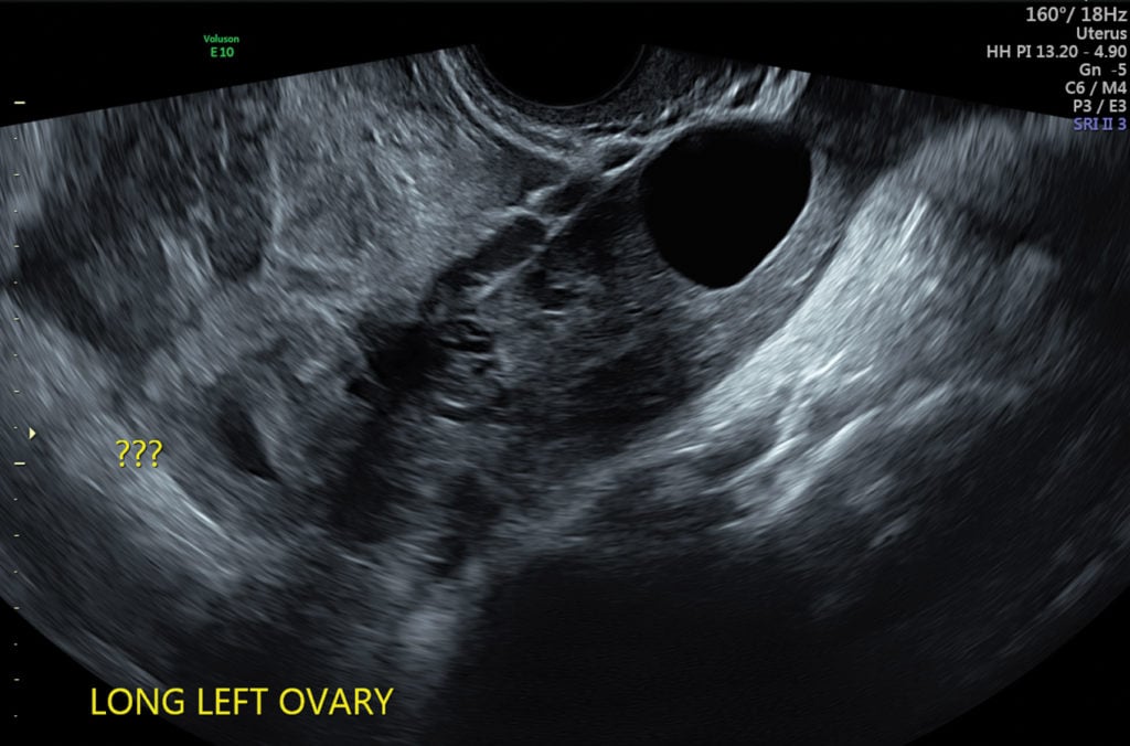 pregnancy sonogram pregnancy sonogram