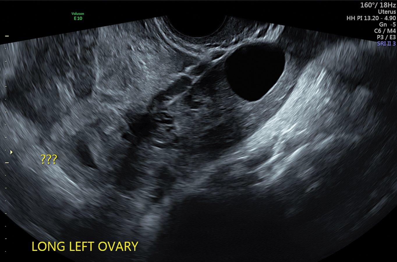 Figure 2. Ultrasound findings suggestive of left tubal ectopic pregnancy.