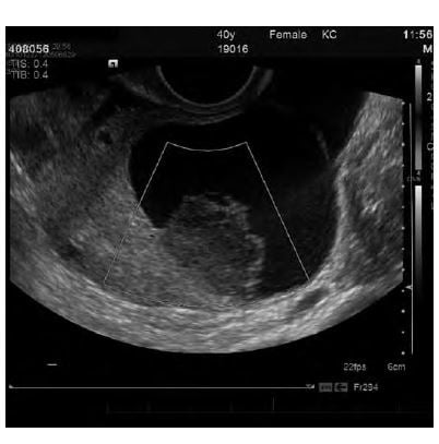 Transvaginal pelvic ultrasound images of a 40 yo patient with classic onset of severe left iliac fossa pain. Absence of arterial and venous flow on colour doppler imaging, in an enlarged ovarian mass, the lead point for the ovarian torsion. The histopathology confirmed a torted ovary containing a benign simple cyst with marked oedema of the residual ovarian stroma.