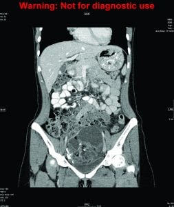 anti-NMDA-receptor encephalitis and ovarian teratoma