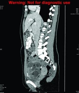 Figure 1. CT abdomen/pelvis (Coronal and Sagittal): A 12x7x11cm multi-loculated solid and cystic pelvic mass, with punctate calcified and fat density foci in keeping with a large ovarian teratoma. No ascites, peritoneal or pulmonary disease, lymphadenopathy or bony lesions. Courtesy of Liverpool Hospital Radiology Department.