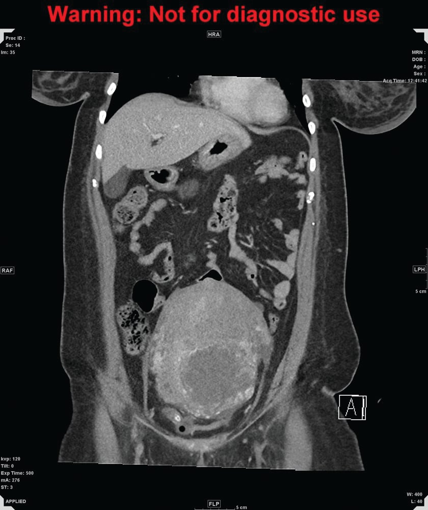 Figure 1a. CT of abdomen and pelvis, coronal