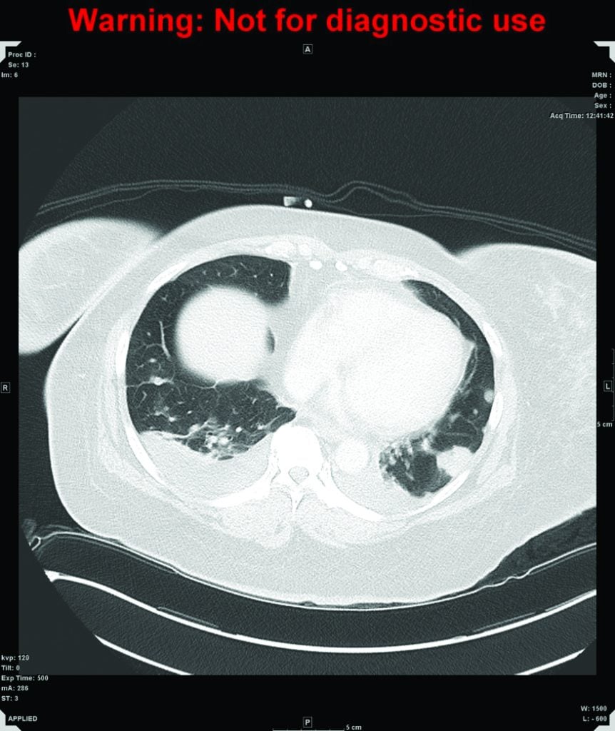 Figure 2. CT of chest. Multiple nodules are scattered throughout the lung affecting both lungs and all lobes, consistent with lung metastases, with a halo of ground-glass change around the nodules which may be secondary to haemorrhage.