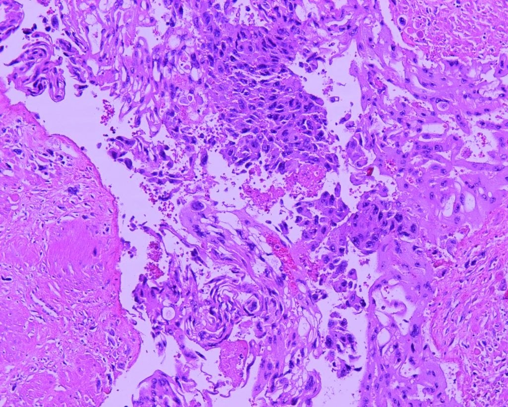 Figure 4. The uterus with attached cervix weighed 1168g and measured 17cm in largest diameter. The choriocarcinoma tumour is composed of diffusely infiltrative sheets and nodules of trimorphic intermediate trophoblasts and cytotrophoblasts rimmed by multinucleated syncytiotrophoblasts with extensive haemorrhage and necrosis. Pleomorphism and mitotic activity is seen. The tumour involves more than 50 per cent of the myometrium and extends into the lower uterine segment and cervix. There is lymphovascular invasion. [H&E stain].