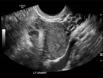 Figure 2. Left ovarian cyst and moderate free fluid in pouch of Douglas. 