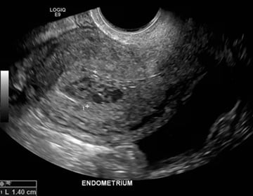 Figure 1. Heterogenous intrauterine material.