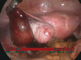 Figure 4. Intraoperative image of left ectopic pregnancy. 