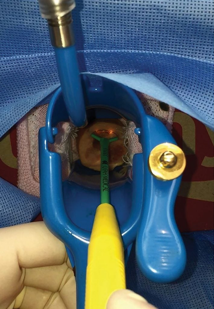 Figure 1. Surgical simulation for skills in LLETZ procedure.