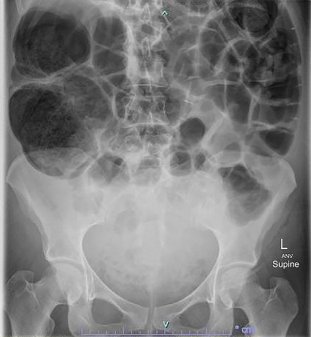 Ogilvie’s syndrome a fourth trimester reality O&G Magazine