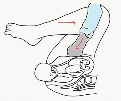 Figure 1. Rubin I manoeuvre.