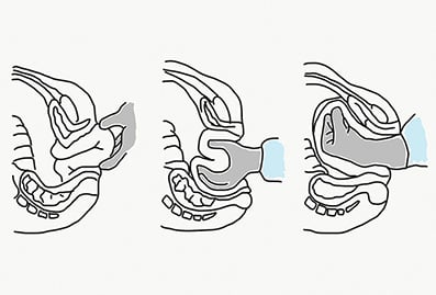 Figure 5. Johnson’s manoeuvre.