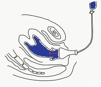 Figure 6. O’Sullivan’s method.