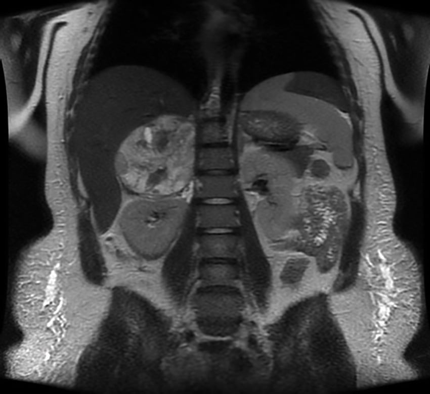 Figure 1. Postpartum MRI of neck, chest abdomen and pelvis, showing a large mass arising in the region of the right adrenal gland (consistent with a phaeochromocytoma). It abuts a number of adjacent structures but does not obviously appear to be invading any of these structures. No evidence of any metastatic disease identified within the abdomen. No obvious evidence of any other masses identified other than the patient’s physiologically enlarged postpartum uterus.