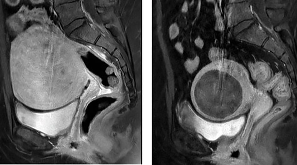 Figure 1. Sagittal MRI T1 post-contrast. a) Pre-embolisation, demonstrating large enhancing fibroid b) Post-embolisation, showing volume reduction and non-enhancement of the fibroid.