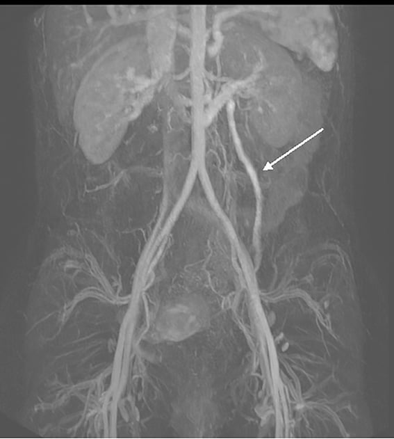 Figure 2. MR venogram demonstrating incompetent left ovarian vein.