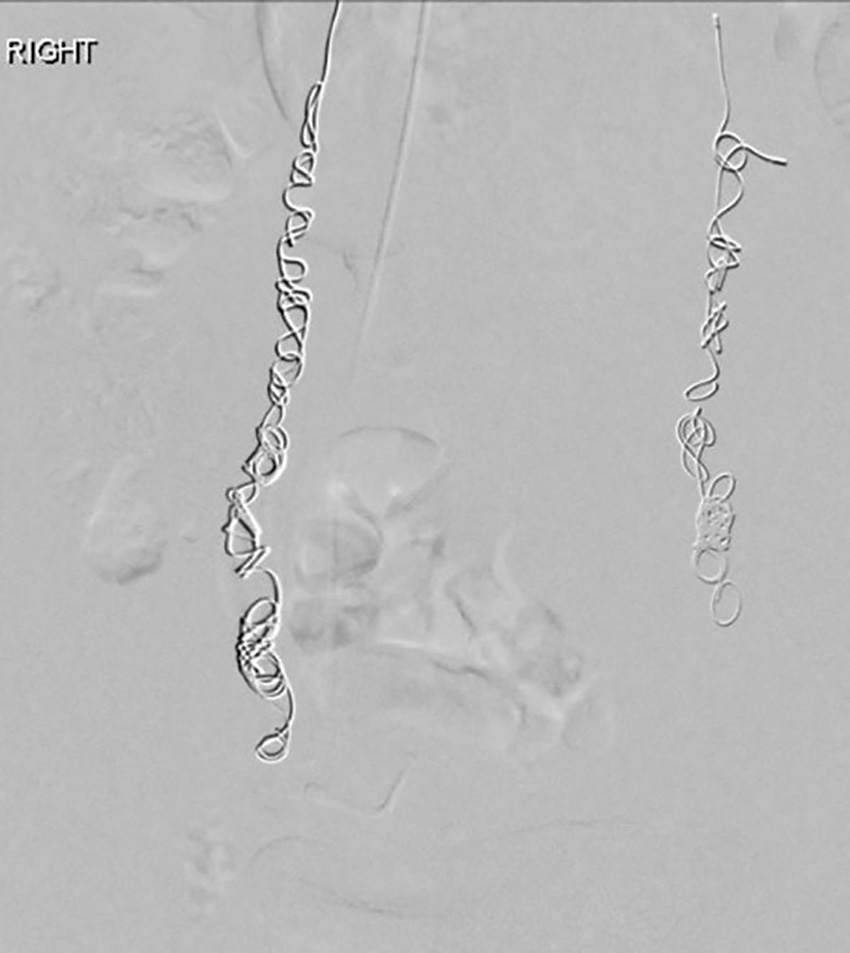 Figure 2b. Post-embolisation with coils in both ovarian veins.