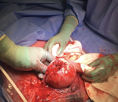 Figure 1. Fundal uterine rupture through myomectomy scar.