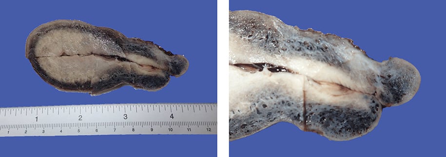 Figure 1. (Right) The uterus shows a continuous peripheral rim of dark purple discoloration. (Left) The area of discoloration appears to be representing numerous congested blood vessels. 