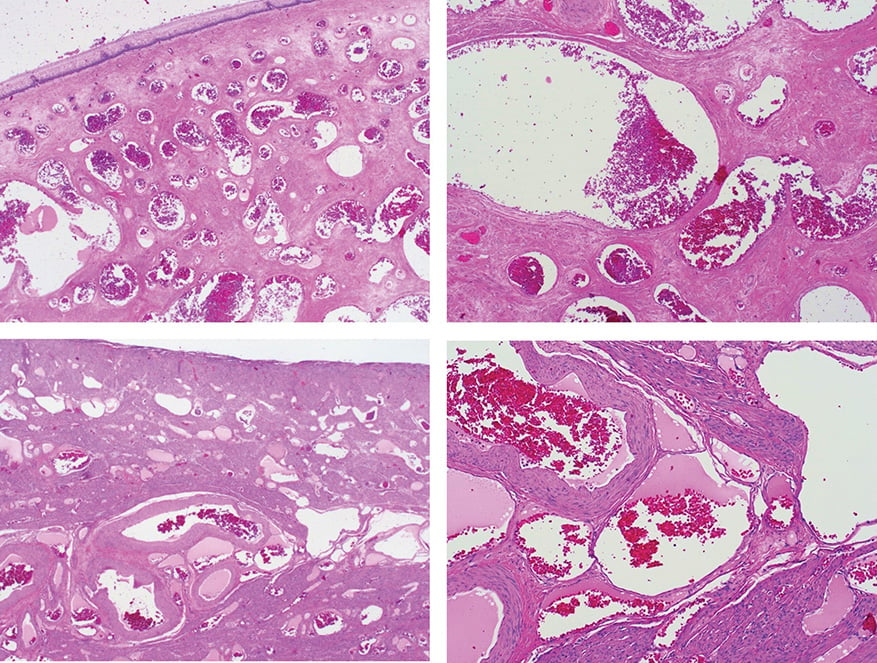 Figure 2. (Top right and left, H&E) Uterine cervix show numerous ectatic vascular channels lined by benign endothelial cells. (Bottom right and left, H&E) Uterine corpus similarly show vascular channels of varying sizes extensively involving the myometrium. 