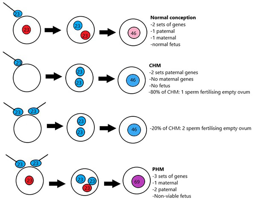 Figure 1. Molar pregnancy genetics.