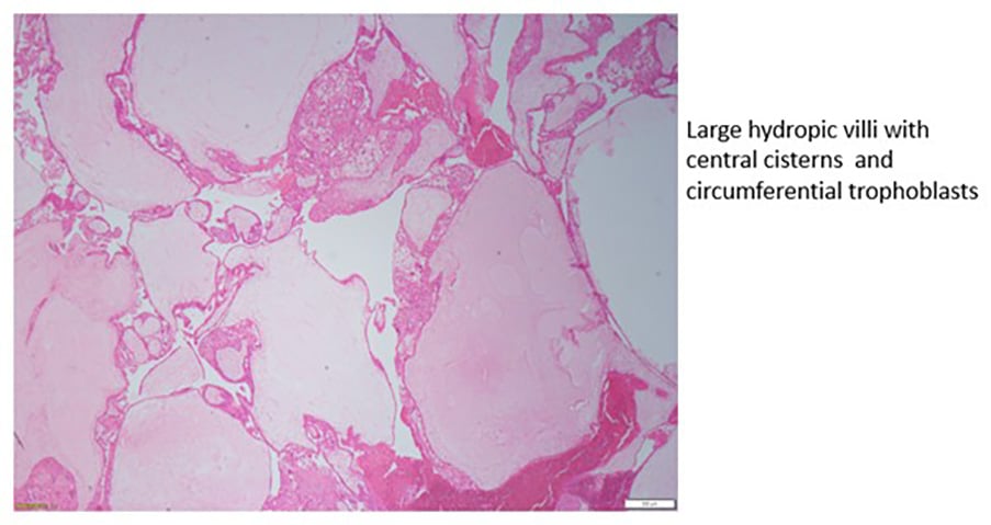 Figure 2a. Complete hydatidiform mole.