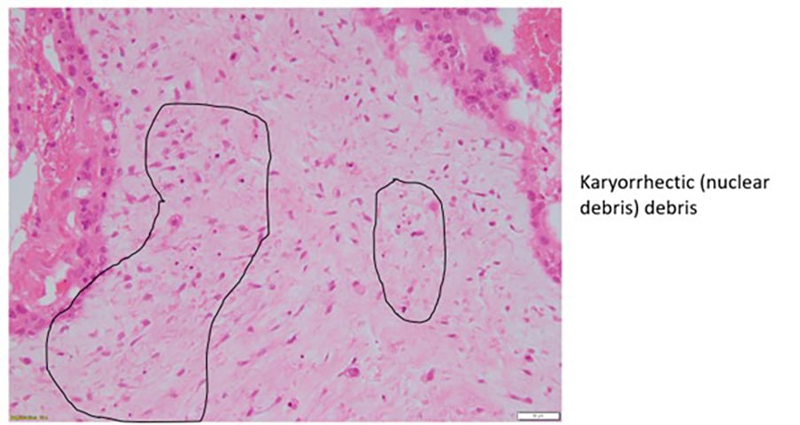 Figure 2b. Complete hydatidiform mole.