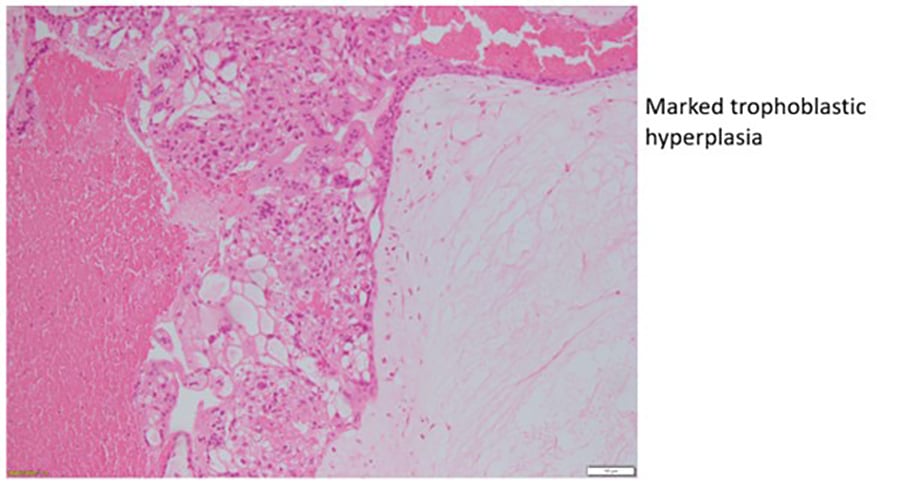 Figure 2c. Complete hydatidiform mole.