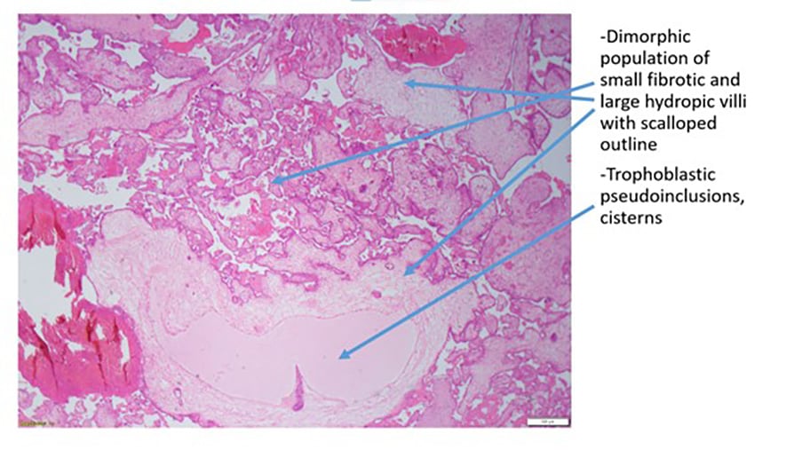 Figure 3a. Partial hydatidiform mole