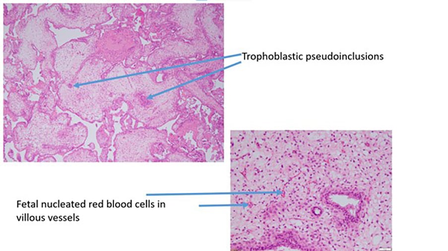 Figure 3b. Partial hydatidiform mole.