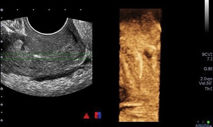 Figure 1. Initial ultrasound scan reported as ‘linear echogenic structure within the endocervical canal that may reflect a malpositioned IUD.’