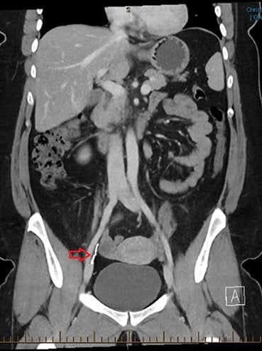 Figure 2. CT abdomen with report stating ‘the Mirena coil is situated outside the uterus, between the right ovary and internal iliac vessels. Appears retroperitoneal and deep to the round ligament.’
