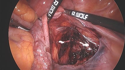 Figure 3. Mirena located in overlying the iliac vessels at laparoscopy.