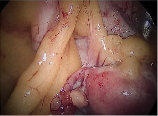 Figure 5. Omental adhesion to uterine fundus, uterus, left fallopian tube and ovary.