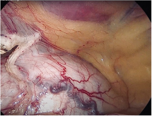 Figure 6. Distended intraperitoneal urinary bladder (post adhesiolysis).