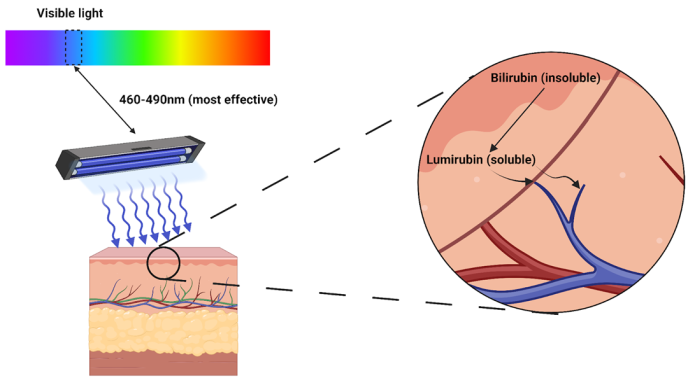 Figure 1. Overview of phototherapy. The use of blue light (with specific wavelengths as described) facilitates isomerisation (or transformation) of bilirubin into lumirubin, a substance capable of direct excretion in GI/GU tracts. Adapted from ‘light’ by BioRender.com (2023), available at https://app.biorender.com/biorender-templates.